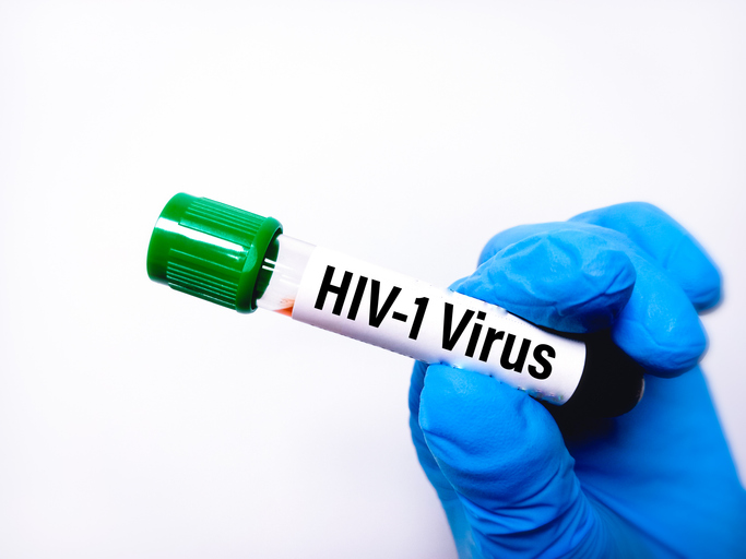 Blood sample for HIV-1 virus test, HIV screening test.